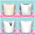 Dental problems, caries, plaque and gum disease, healthy tooth vector illustration