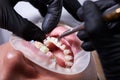 Dental procedure, process of attaching white ceramic braces and steel wire with a help of tongs