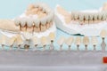 Dental prostheses close up