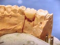 Dental prostheses in semiprocess. Gypsum Stomatologic jaws