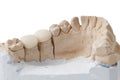 Dental Prosthesis