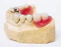 Dental prosthesis Royalty Free Stock Photo