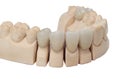 Dental prosthesis Royalty Free Stock Photo