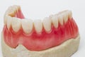 Dental prosthesis Royalty Free Stock Photo