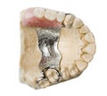 Dental prosthesis