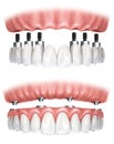 Dental prosthesis