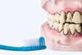 Dental prosthesis with bad teeth, infected gums and tooth brush. dentures showing cavities. Dental Health for prevention