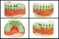 Dental prosthesis model collage Royalty Free Stock Photo