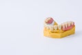 Dental prosthesis over a mold