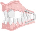 Dental prosthesis