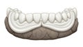 Dental Prosthesis on Stone Model Royalty Free Stock Photo