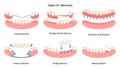 Dental prosthesis types set. Dental implant, partial, snap-in, bridge