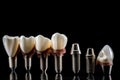 Dental prosthetic teeth on a black background. Dentistry concept. Generative AI