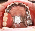 Dental Prosthetics