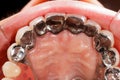 Dental Prosthetics