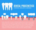 Dental prosthetics illustration