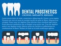 Dental prosthetics illustration