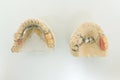 Dental prosthetics, implants. Gypsum model on the table at the dentist