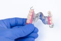 Dental prosthetics. orthopedic dentistry. removable dental prosthetics. upper clasp prosthesis with supporting ceramic-metal