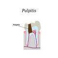 Dental pulp. Vector illustration on