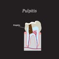 Dental pulp. Vector illustration on a black