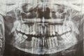 Dental radiography. Digital x-ray teeth scan of adult female.
