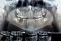 Dental radiography Digital x-ray teeth scan of adult male Royalty Free Stock Photo