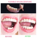 Dental rehabilitation with upper and lower prosthesis, before and after treatment