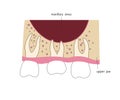 Dental roots in maxillary sinus. Medical illustration in flat style.