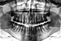 Dental scan x-ray Royalty Free Stock Photo