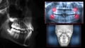 Dental scan x-ray teeth Royalty Free Stock Photo