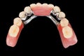 Dental skeletal prosthesis - upper vew