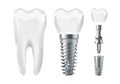 Dental surgery. Implant cut and healthy tooth. Realistic vector dental implant and crown. Stomatology elements Royalty Free Stock Photo