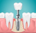 Dental surgery. Tooth implant cut vector illustration. Healthy teeth and dental implant, stomatology poster