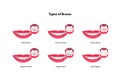 Dental teeth braces types infographic. Vector flat healthcare illustration set. Smile mouth with tooth. Different type of brace