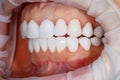 Dental of teeth close up. Teeth whitening image. Bleach veneers. Dental photography