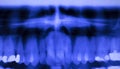 Dental teeth filling dentists xray scan