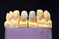 Dental teeth implant