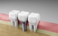 Dental teeth implants. Oral health and dental inspection teeth. Medical dentist tool, children healthcare, 3D render