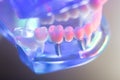Dental healthy teeth implants