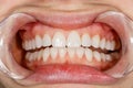 Dental of teeth after treatment. Photo of teeth close up. Teeth whitening image. Treatment plan for new smile. Making bleach