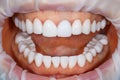 Dental of teeth after treatment. Photo of teeth close up. Teeth whitening image. Treatment plan for new smile. Making bleach