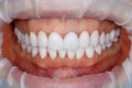 Dental of teeth after treatment. Photo of teeth close up. Teeth whitening image. Treatment plan for new smile. Making bleach