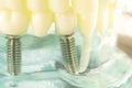 Dental titanium tooth implant