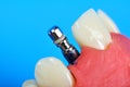 Dental titanium implant