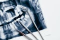 Dental toold and jaw x-ray. Dental treatment concept