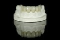 Dental Tooth Bridge Royalty Free Stock Photo