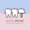 Dental Tooth Implant Installation