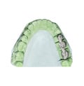 Dental tooth implant plaster pattern with metal bridge isolated