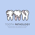 Dental Tooth Pathology and Decay